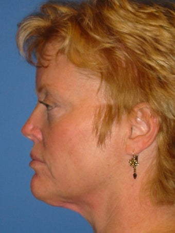 Browlift