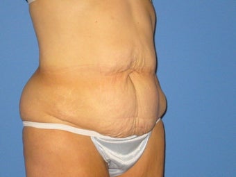 Torsoplasty