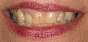 Porcelain Veneers