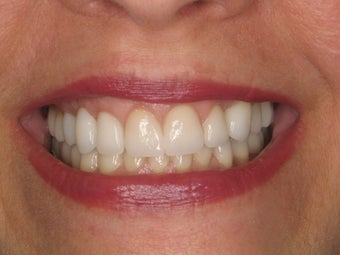 Porcelain Veneers