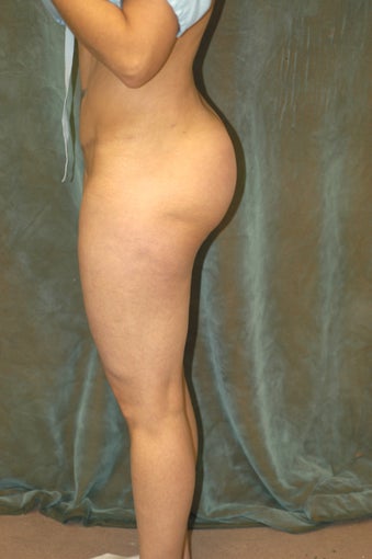 Butt Augmentation