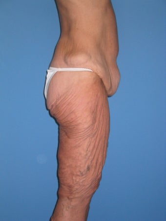 Torsoplasty