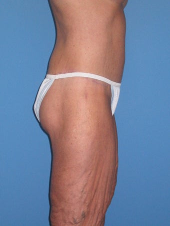 Torsoplasty