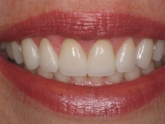 Gingival recontouring, Porcelain Veneers