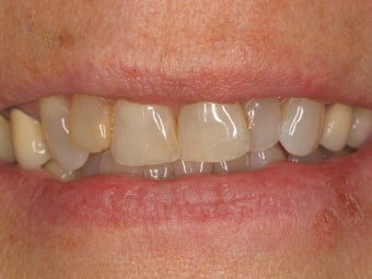 12 Porcelain Veneers