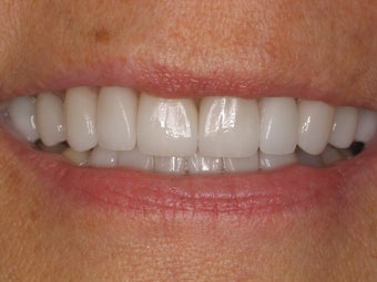 12 Porcelain Veneers