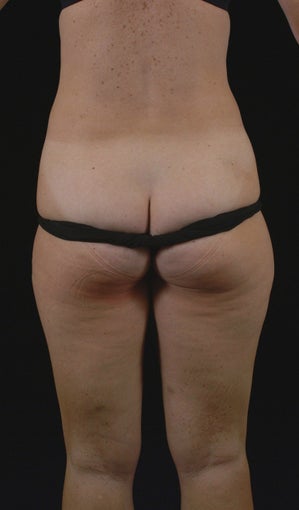 Liposuction