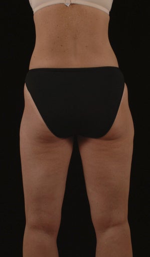Liposuction