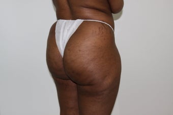 Brazilian Butt Lift