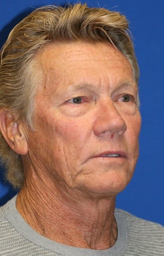 Facelift, Upper Blepharoplasty, Lower Blepharoplasty, & Lower Eyelid Skin Pinch