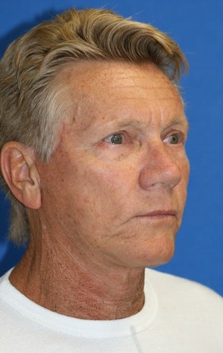 Facelift, Upper Blepharoplasty, Lower Blepharoplasty, & Lower Eyelid Skin Pinch