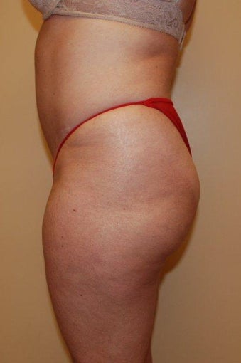 Buttock Augmentation