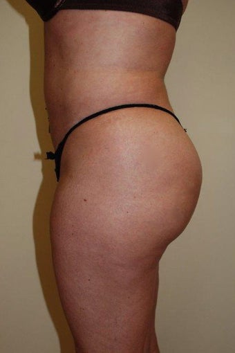 Buttock Augmentation