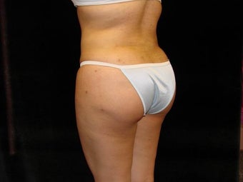 Buttocks Augmentation