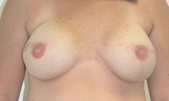 Breast Reconstruction