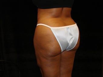 Buttocks Augmentation
