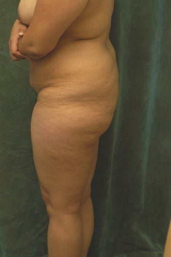 Buttocks Augmentation