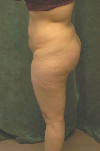 Buttocks Augmentation