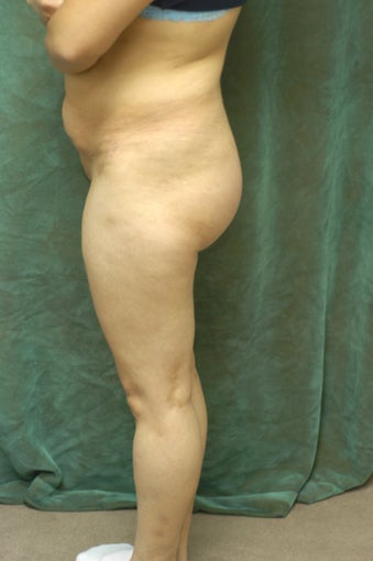 Women's Buttocks Augmentation 