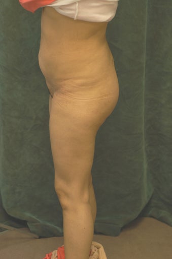 Women's Buttocks Augmentation