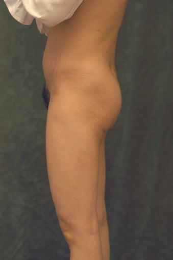 Women's Buttocks Augmentation 