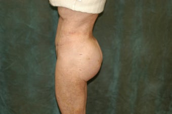 Women's Buttocks Augmentation 