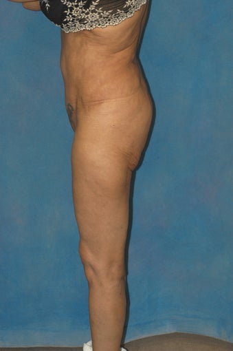 Women's Buttocks Augmentation 