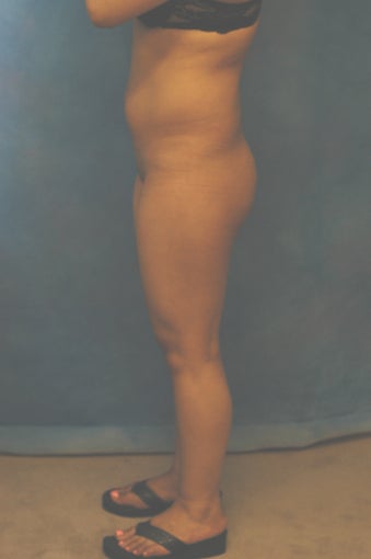 Women's Buttocks Augmentation
