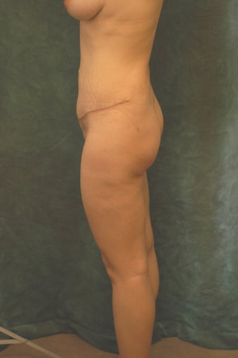 Women's Buttocks Augmentation  
