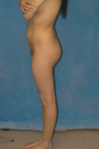 Women's Buttocks Augmentation  