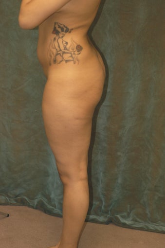Women's Buttocks Augmentation
