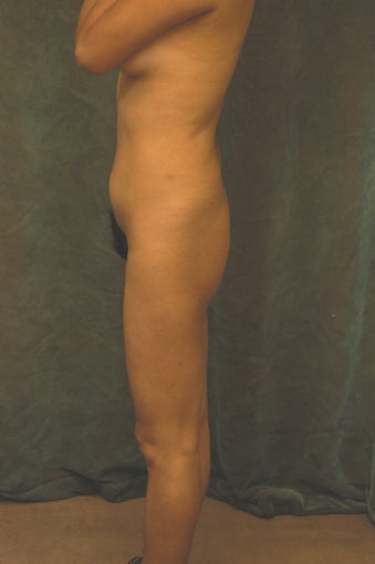 Women's Buttocks Augmentation  
