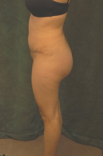Women's Buttocks Augmentation  