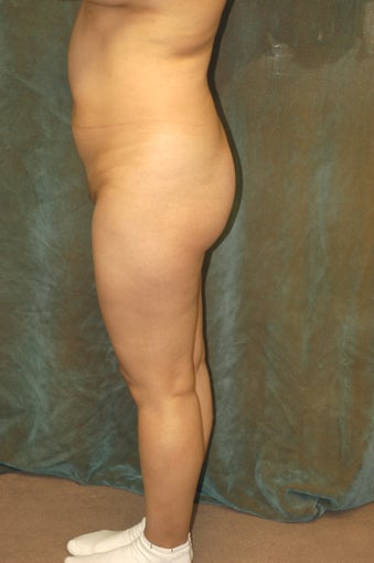 Women's Buttocks Augmentation 