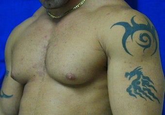 Male Breast Reduction
