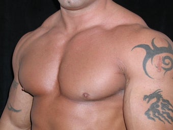 Male Breast Reduction