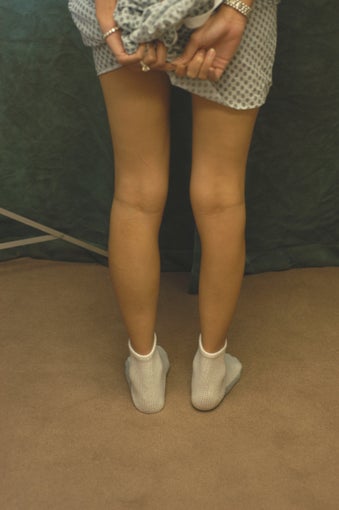 Women's Calf Augmentation 