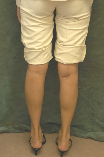 Women's Calf Augmentation 