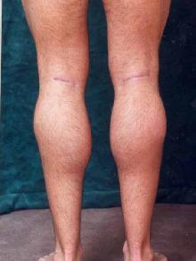 Men's Calf Augmentation 
