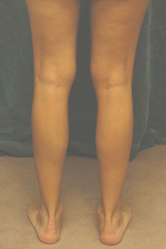 Men's Calf Augmentation  