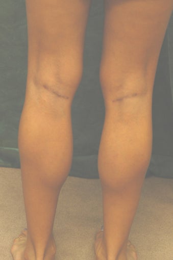 Men's Calf Augmentation  