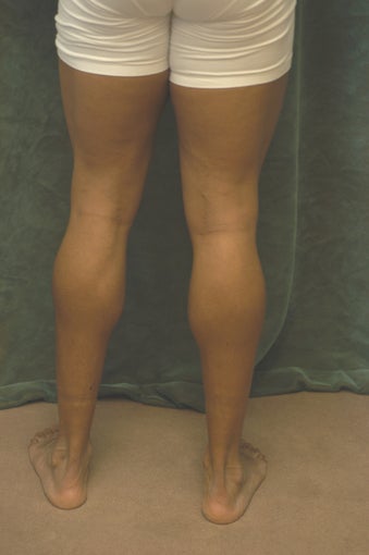 Men's Calf Augmentation 