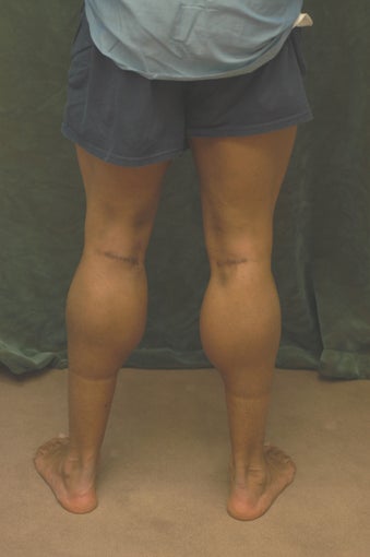 Men's Calf Augmentation 