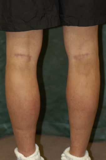 Men's Calf Augmentation  