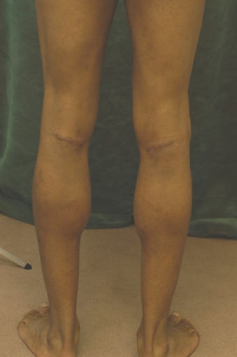 Men's Calf Augmentation 