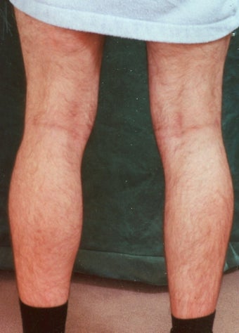 Men's Calf Augmentation 