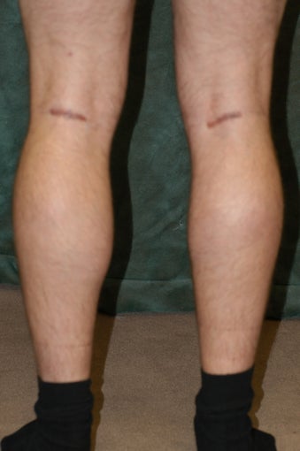 Men's Calf Augmentation 