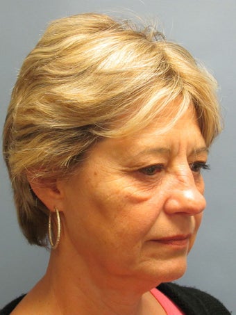 Brow Lift, Eyelid Lift