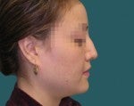 Nose Surgery -Rhinoplasty