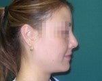 Nose Surgery -Rhinoplasty